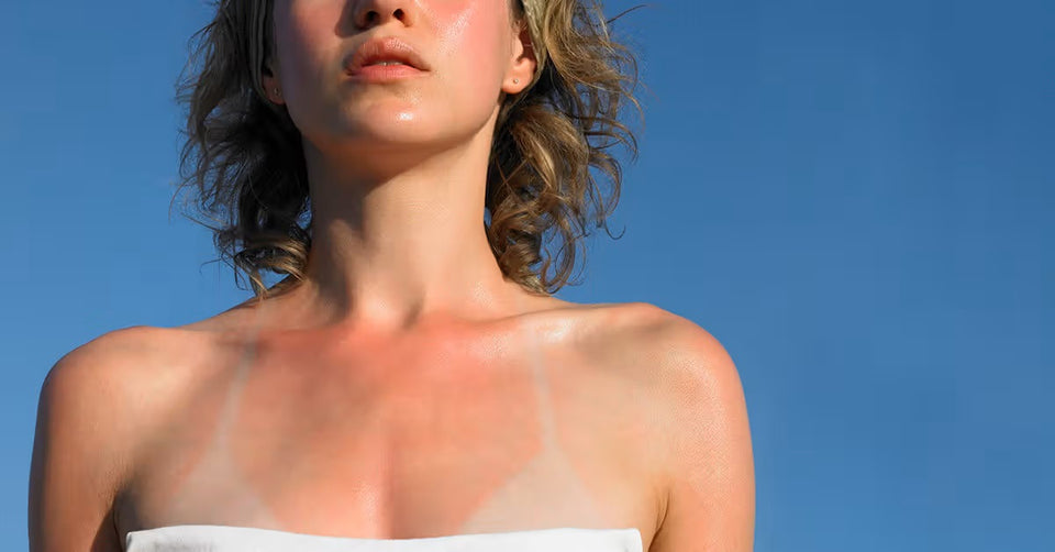 Oops! Messed up your SPF application? We've got you covered with these 3 expert ways to heal that pesky sunburn!